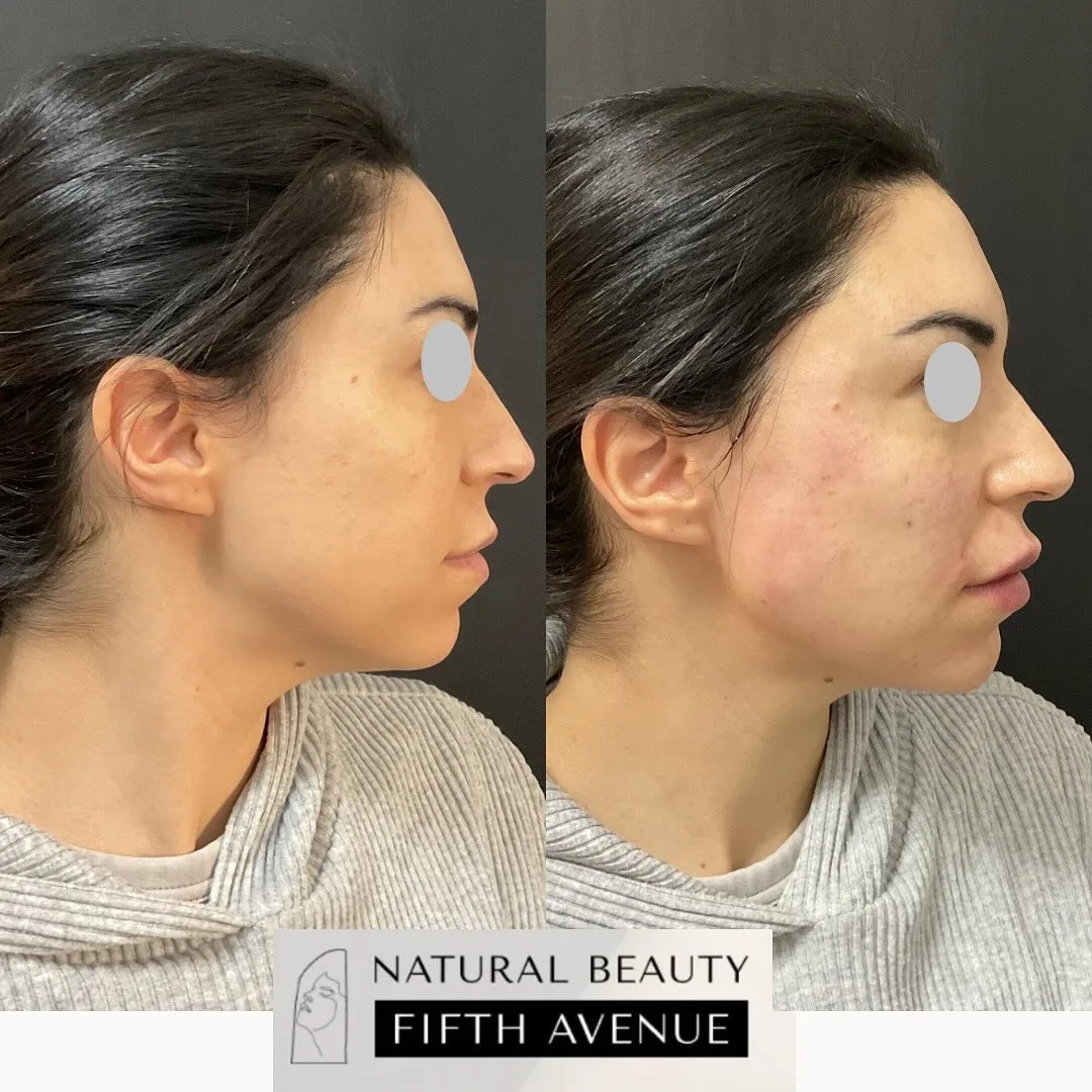 Dermal Fillers Case 2 before and after at Natural Beauty NYC (2 of 4)