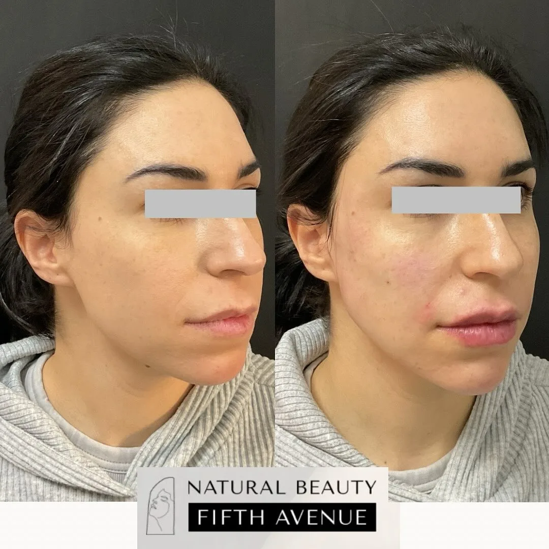 Dermal Fillers Case 2 before and after at Natural Beauty NYC (4 of 4)
