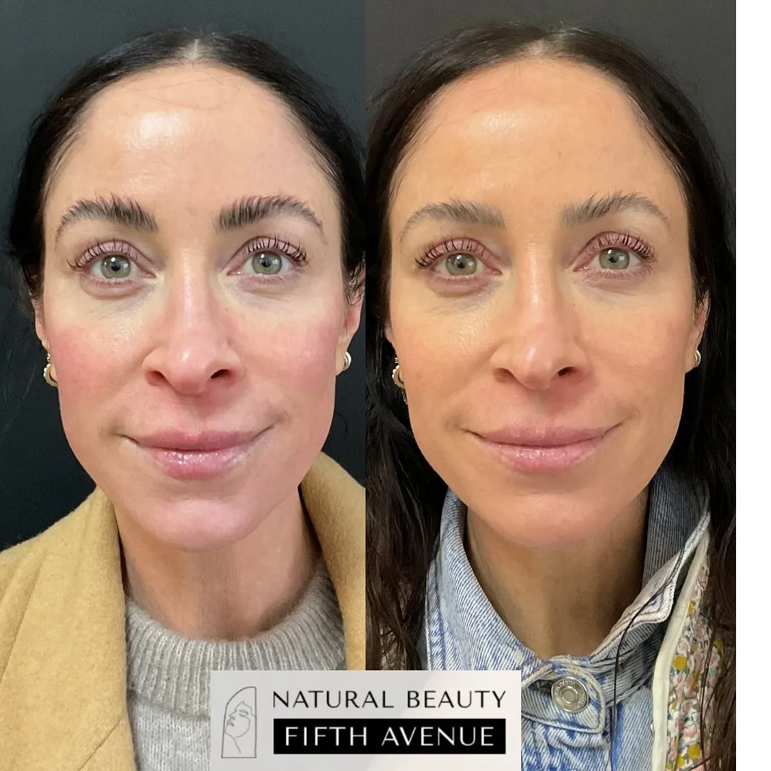 Rosacea Relief with IPL before and after at Natural Beauty NYC (2 of 3)