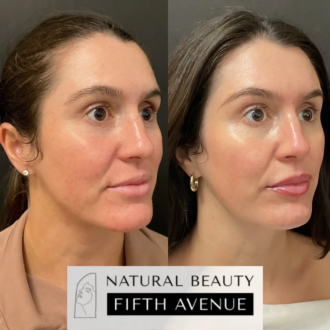 Skincare and Oral Medication before and after at Natural Beauty NYC (3 of 5)