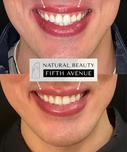Lip Filler before and after