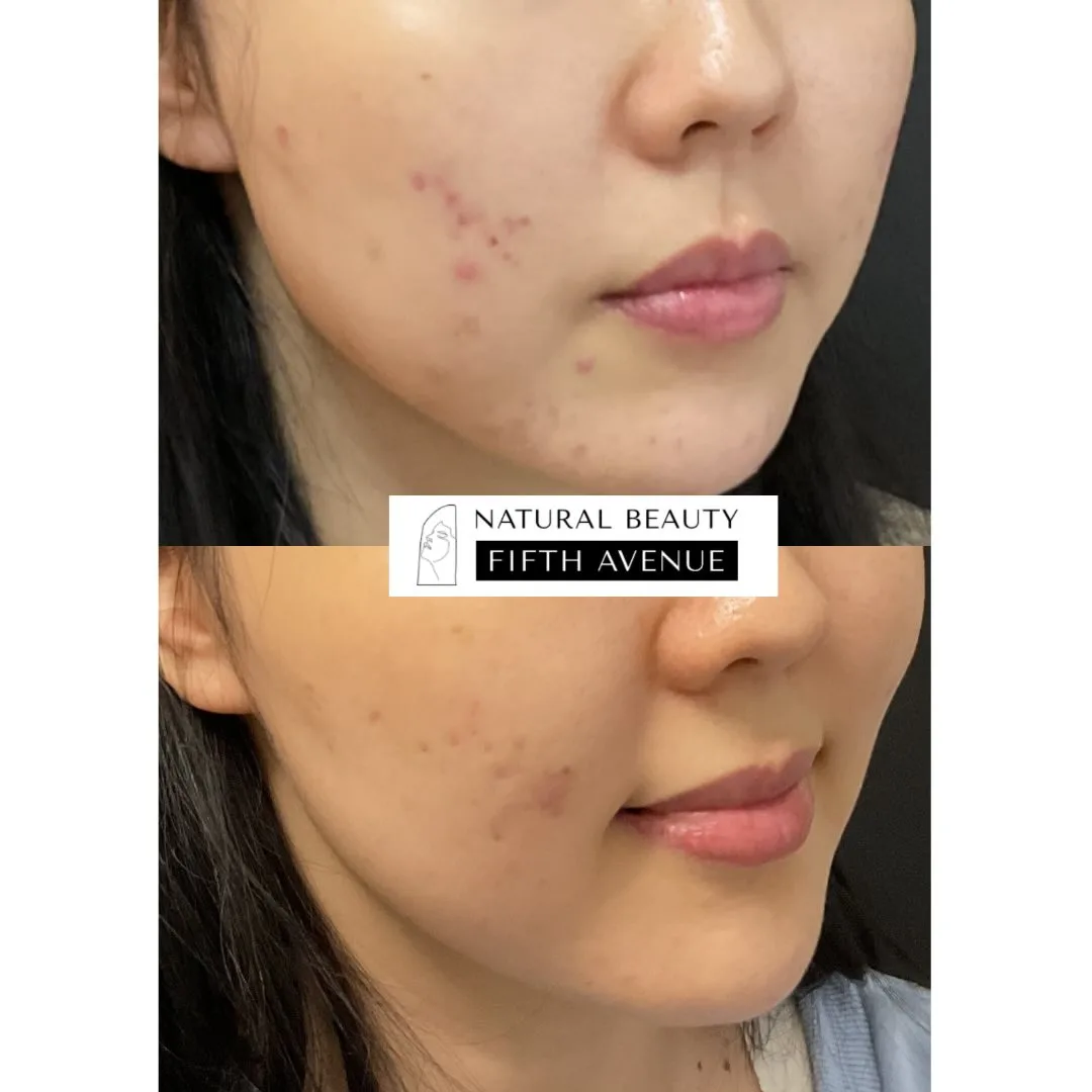 Chemical Peel Case 2 before and after