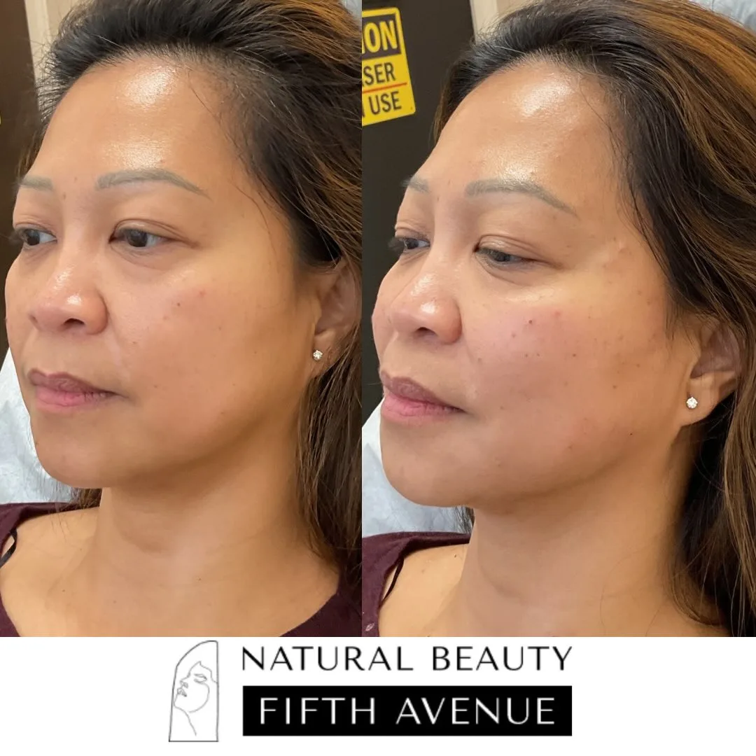 Radiesse Case 2 before and after at Natural Beauty NYC (2 of 4)