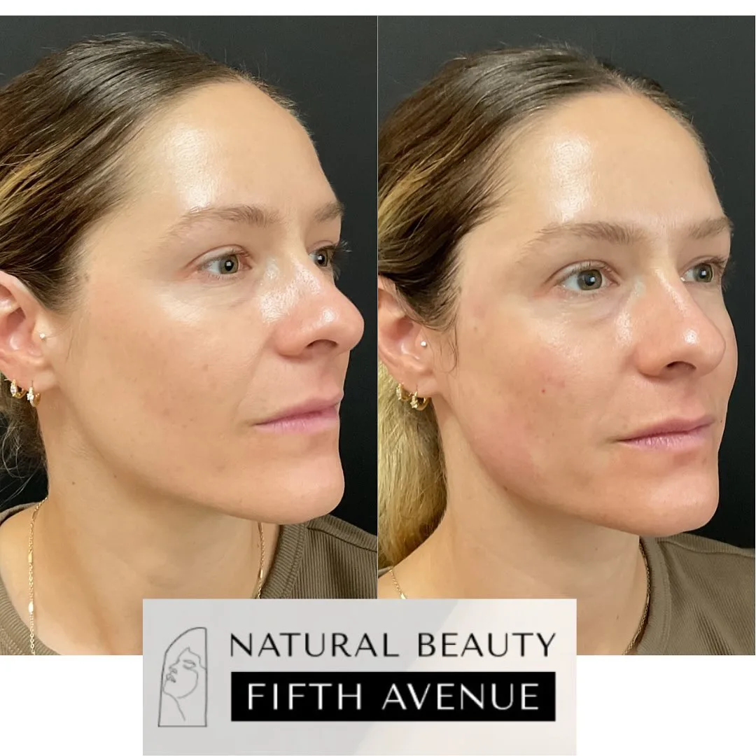 Sculptra Case 1 before and after at Natural Beauty NYC (2 of 3)