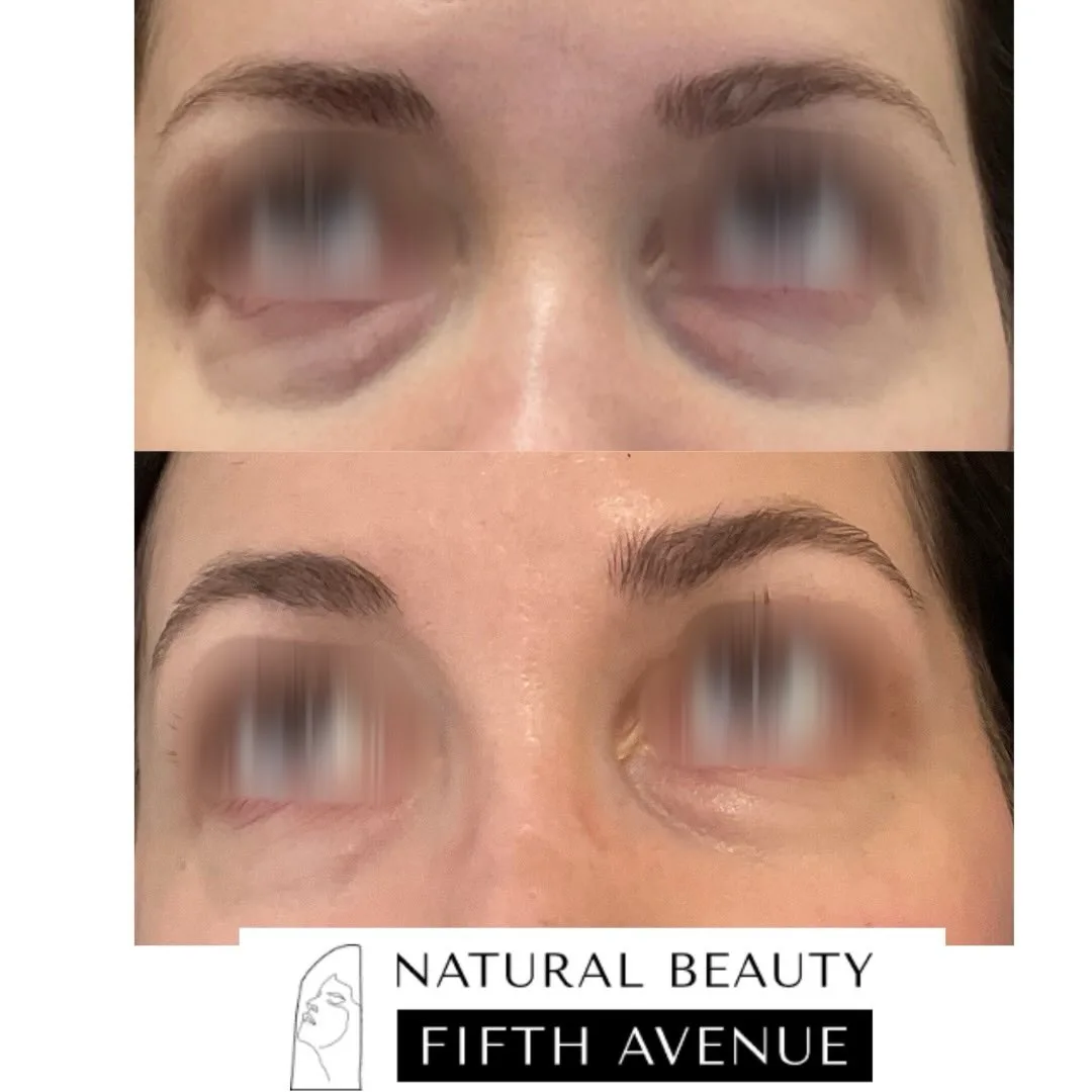 EZ Gel PRF Case 1 before and after