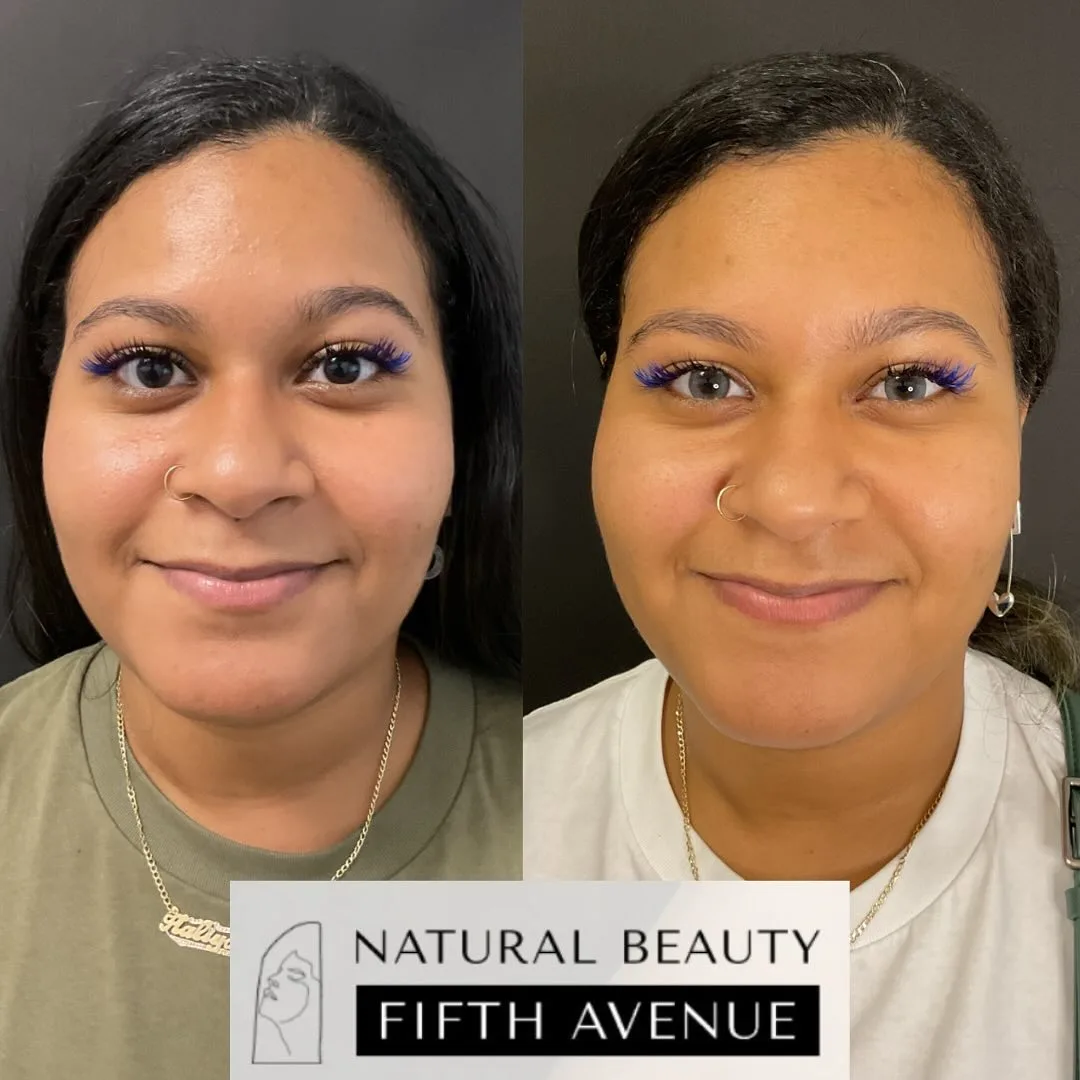 Chemical Peel Case 3 before and after at Natural Beauty NYC (3 of 3)