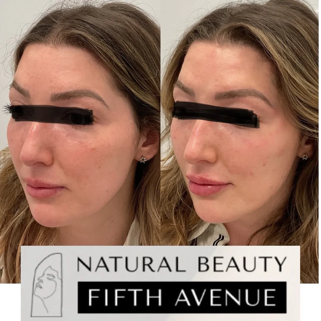 Dermal Fillers before and after at Natural Beauty NYC (2 of 3)