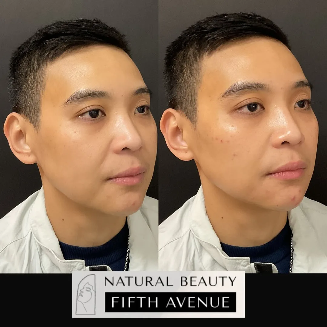 Dermal Filler Case 7 before and after