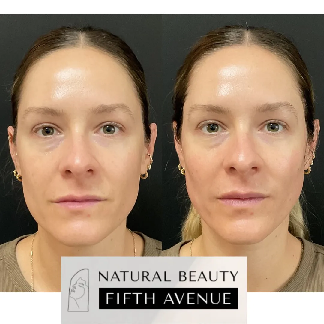 Sculptra Case 1 before and after at Natural Beauty NYC (3 of 3)