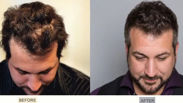 Nsync’s Joey Fatone Gets Hair Transplant from Bosley Banner