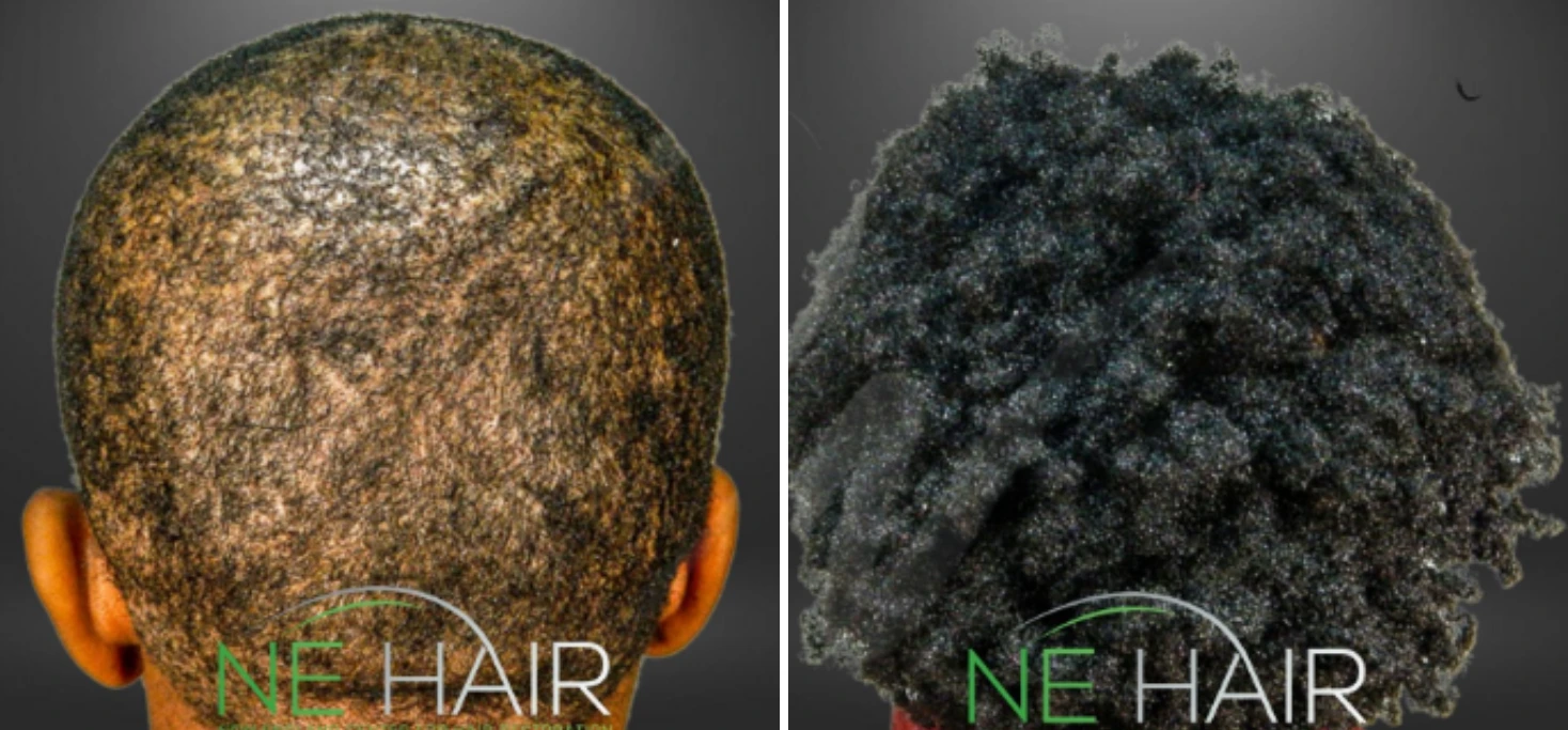 Before and after hair restoration showing sparse scalp from back view transforming to full dark hair coverage