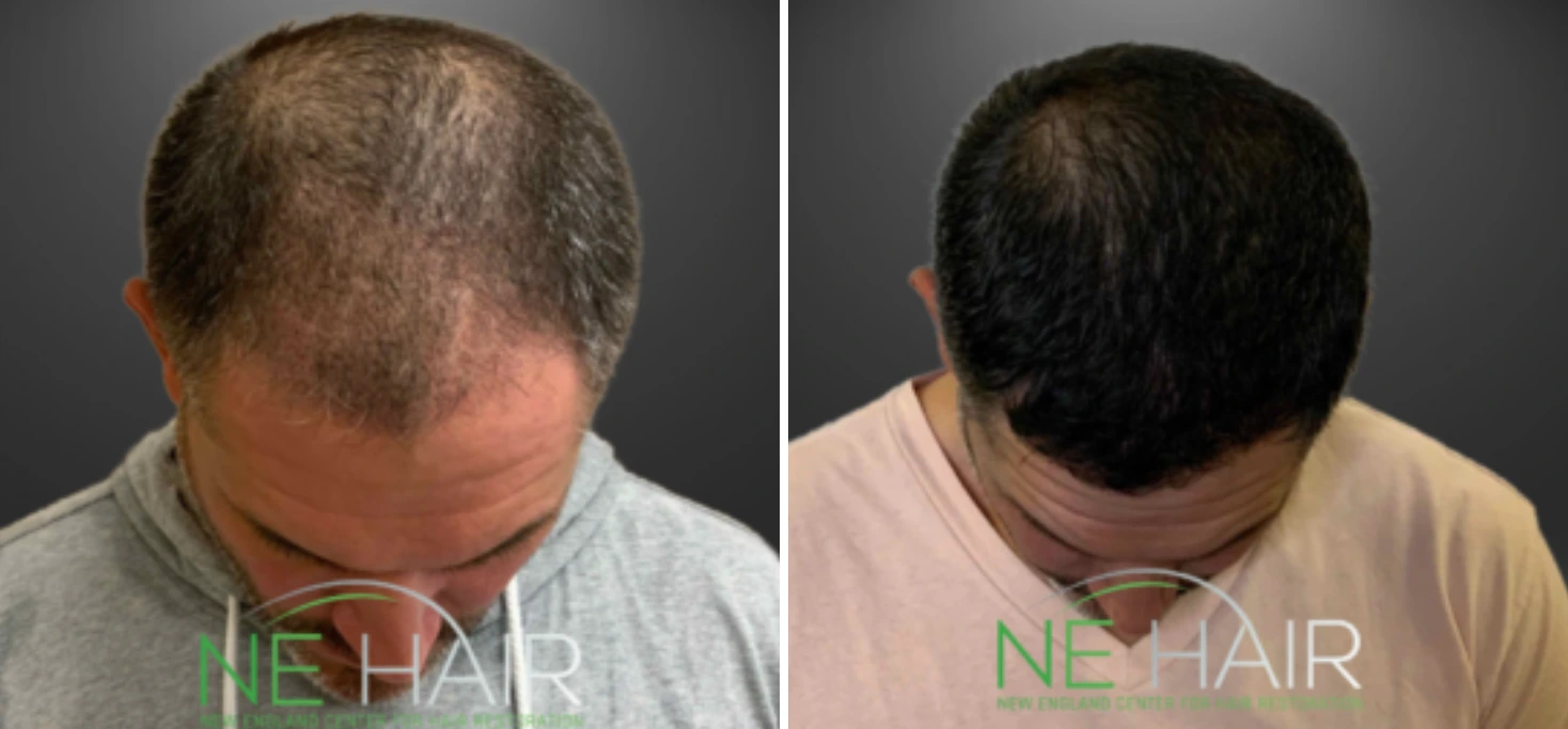 Before and after hair restoration showing thinning crown from top-down view progressing to fuller dark hair