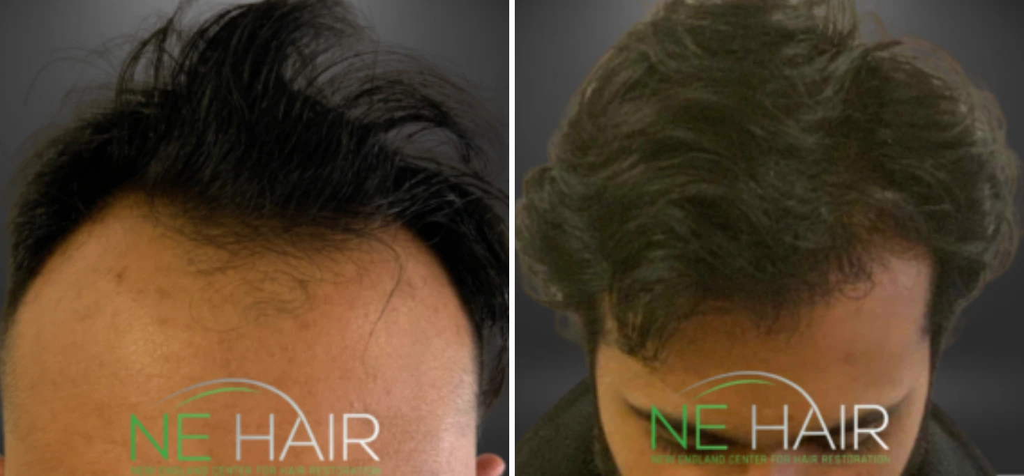 Before and after hair restoration showing receding hairline from front view with restored hair volume
