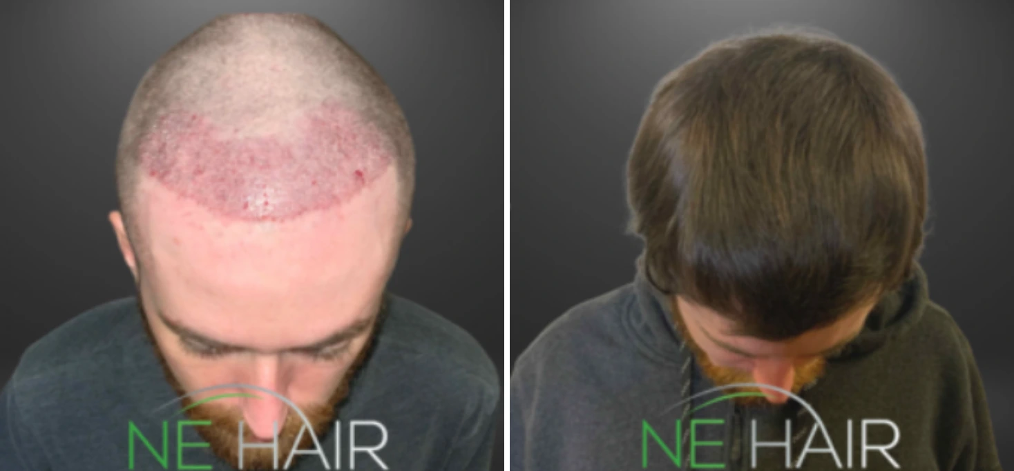 Before and after hair restoration showing significant scalp baldness from front view progressing to full hair coverage from back view