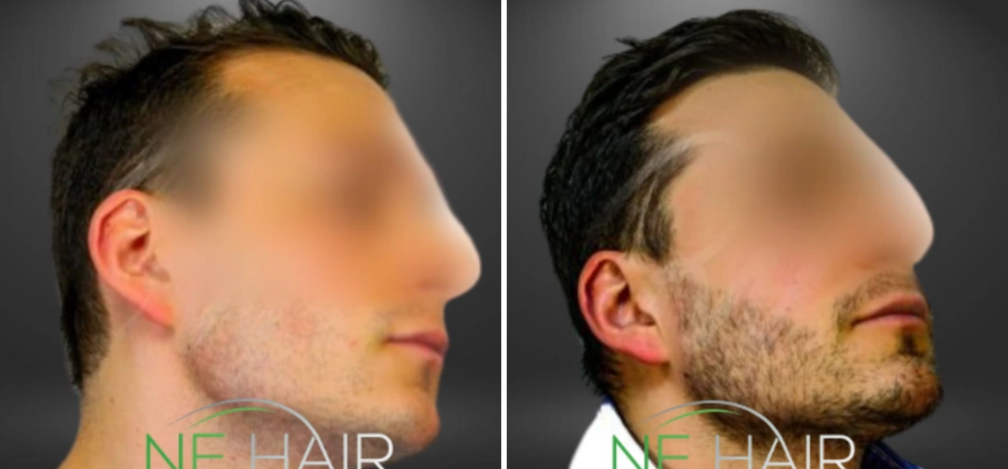 Before and after hair restoration showing side profile with sparse hair transforming to fuller hair growth