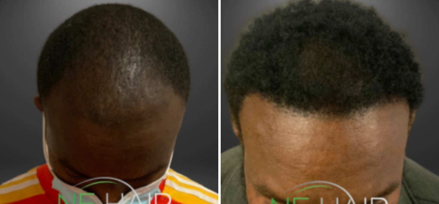 Before and after hair restoration showing sparse scalp from back view progressing to dense textured hair growth