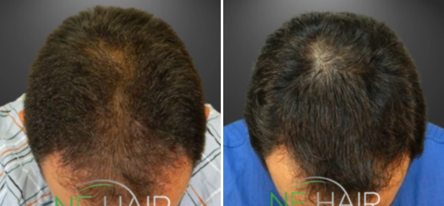 Before and after hair restoration showing rear crown view with improved density and coverage