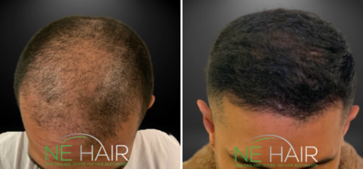 Before and after hair restoration showing crown area with sparse hair progressing to thicker hair growth