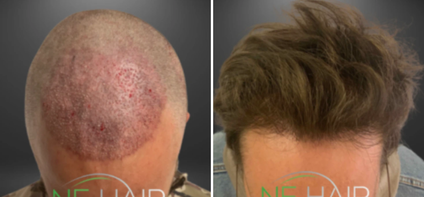 Before and after hair restoration showing bald scalp and restored hair with volume styling
