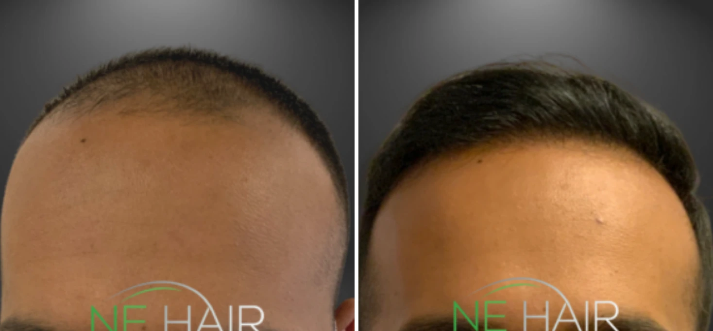Before and after hair restoration showing top view with improved hairline and density