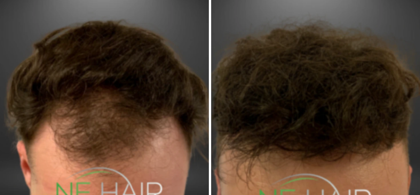 Before and after hair restoration showing rear view with fuller, thicker hair growth