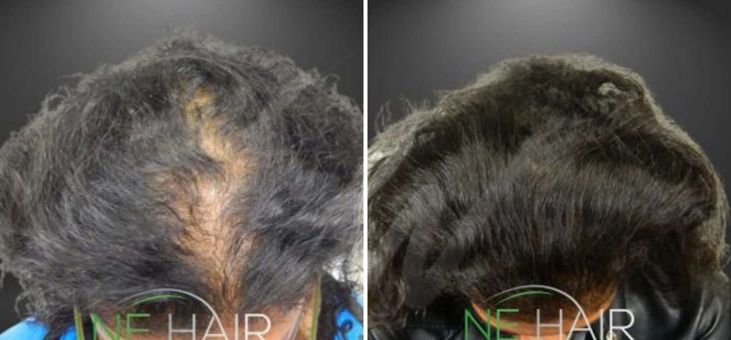 Before and after overhead view of hair restoration on scalp with increased density and coverage