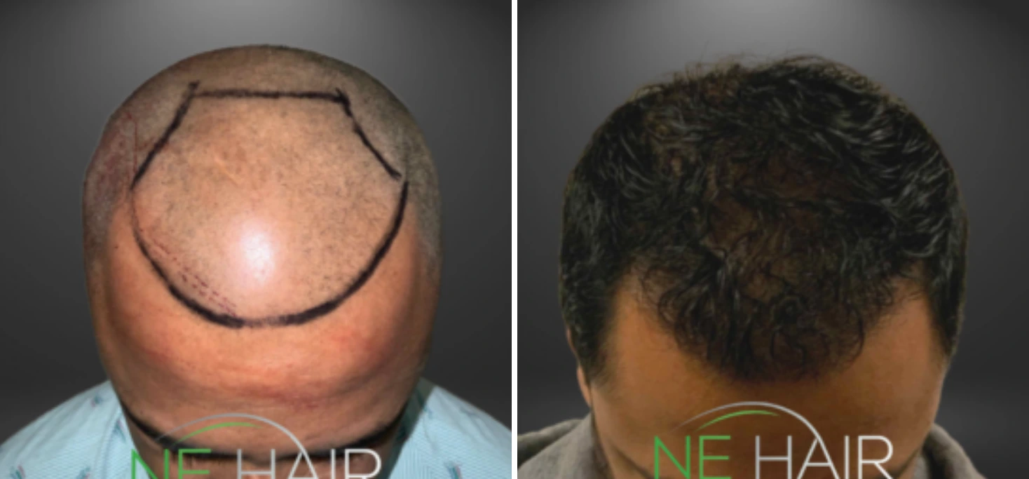 Before and after top view of hair restoration with surgical markings showing transplant area and final results