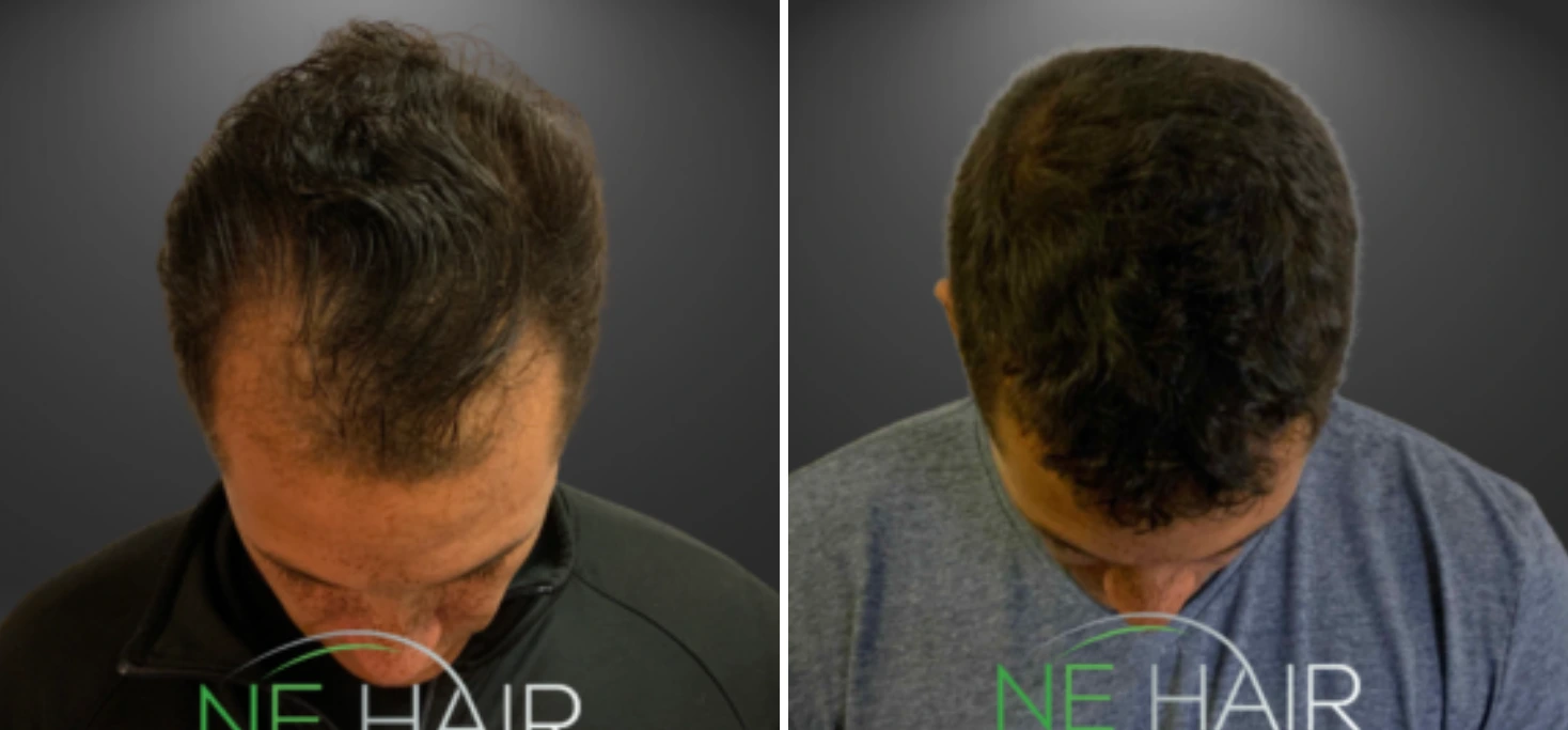 Before and after back view of hair restoration on crown with improved density and natural appearance
