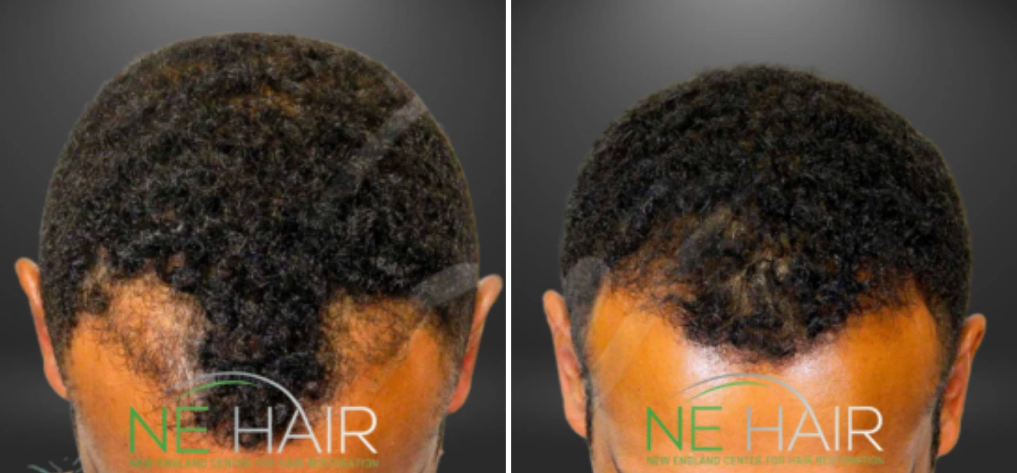 Before and after back view of hair restoration showing fuller coverage on scalp vertex