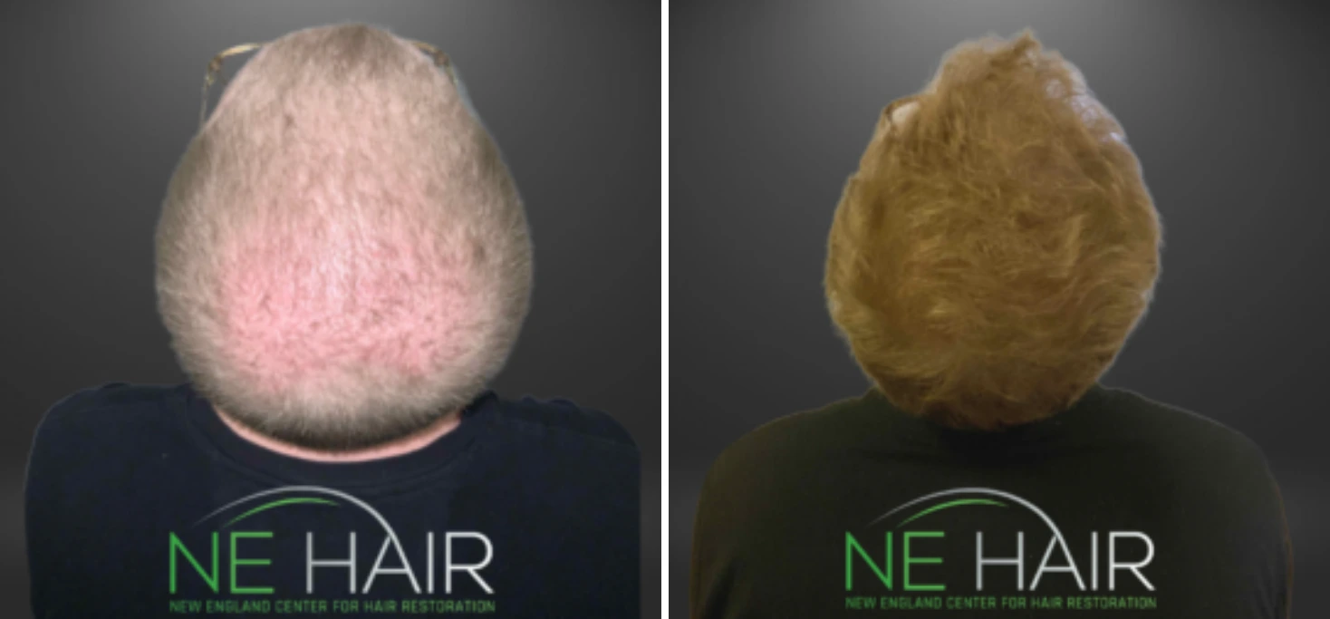 Before and after back view of hair restoration showing darker, fuller hair growth on previously sparse scalp