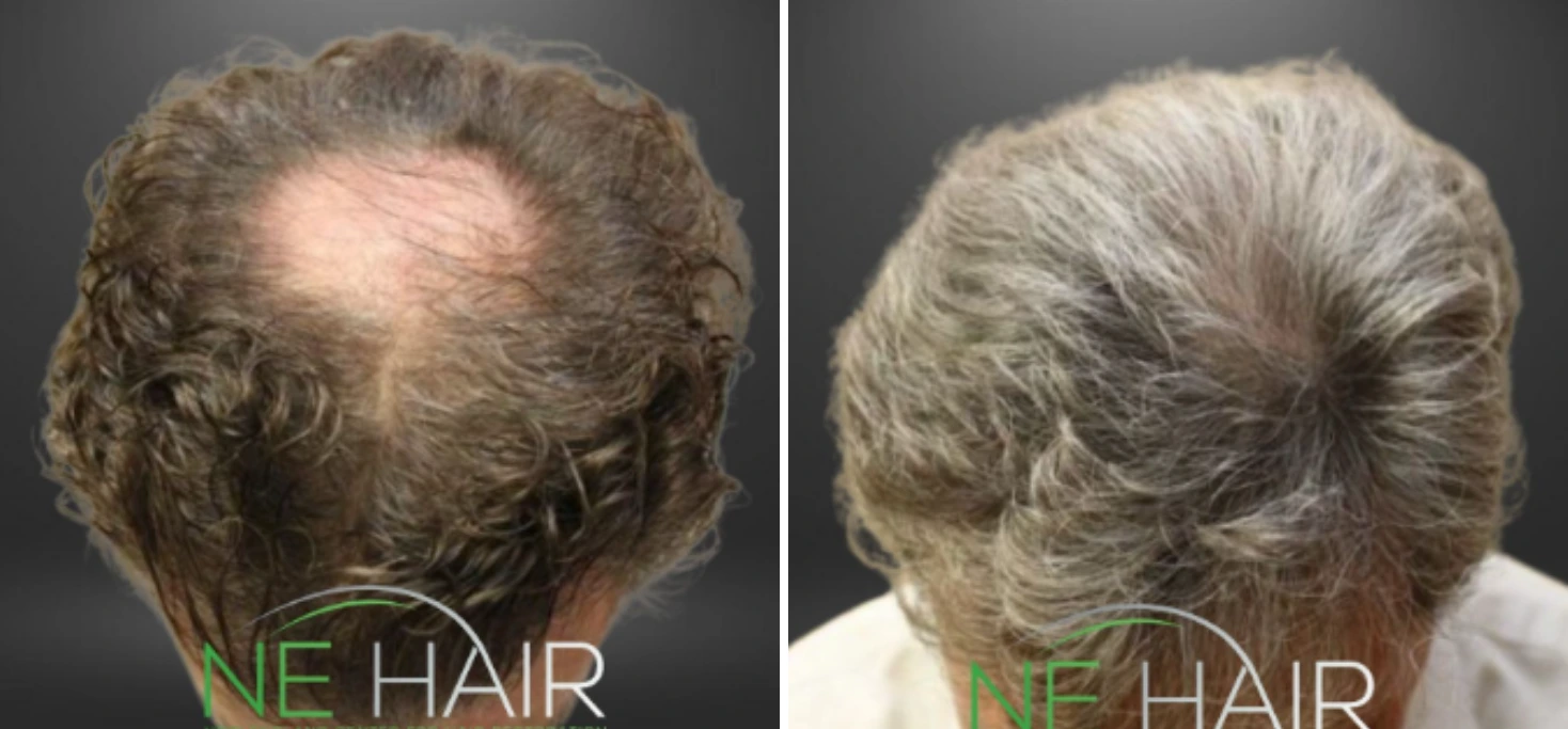 Before and after views of scalp showing hair restoration results, rear view