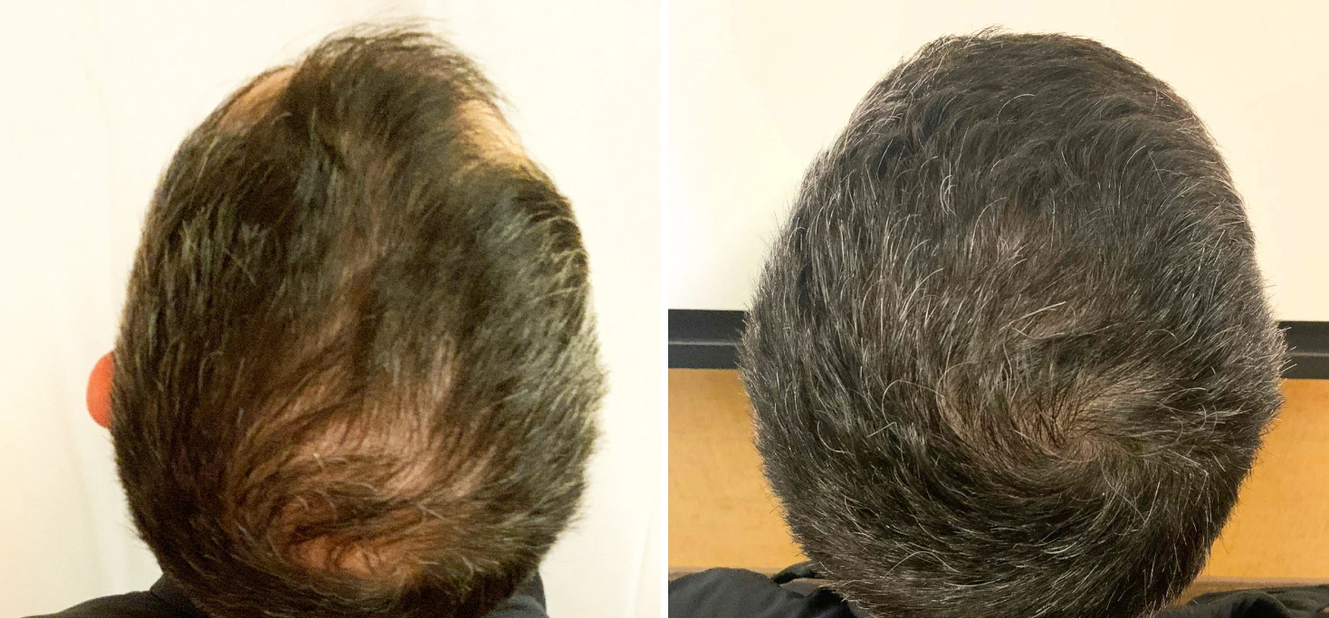 Before and after rear view showing increased hair coverage and darker hair appearance