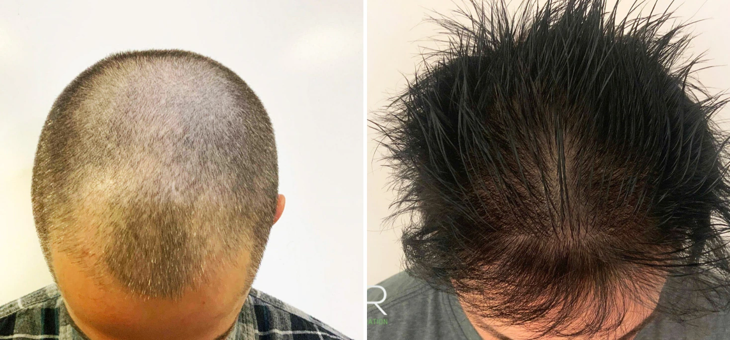 Before and after rear view showing transformation from minimal to full dark hair coverage