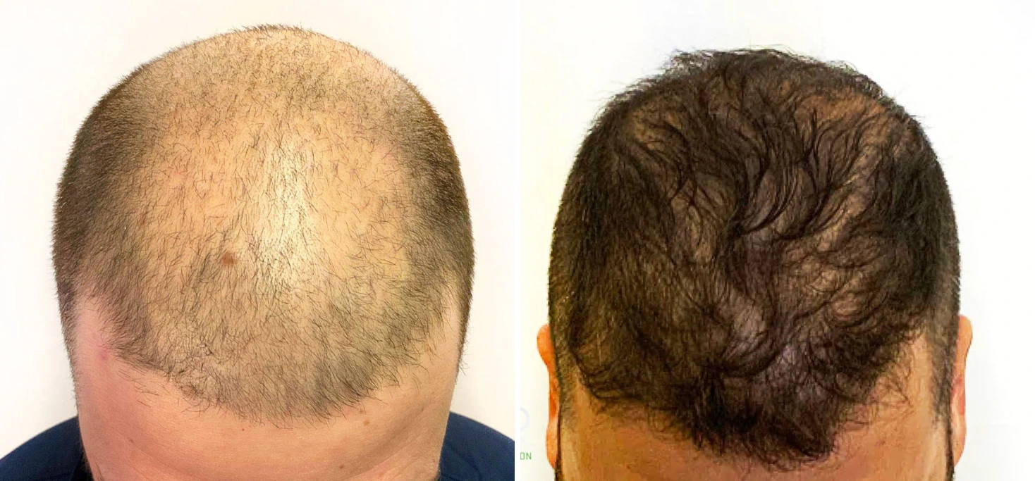 Before and after hair restoration: bald crown on left, full dark hair growth on right