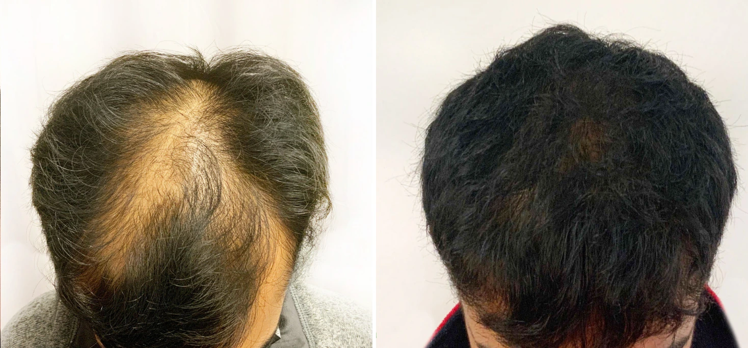 Before and after hair restoration: sparse hair loss on left, thick dark hair coverage on right