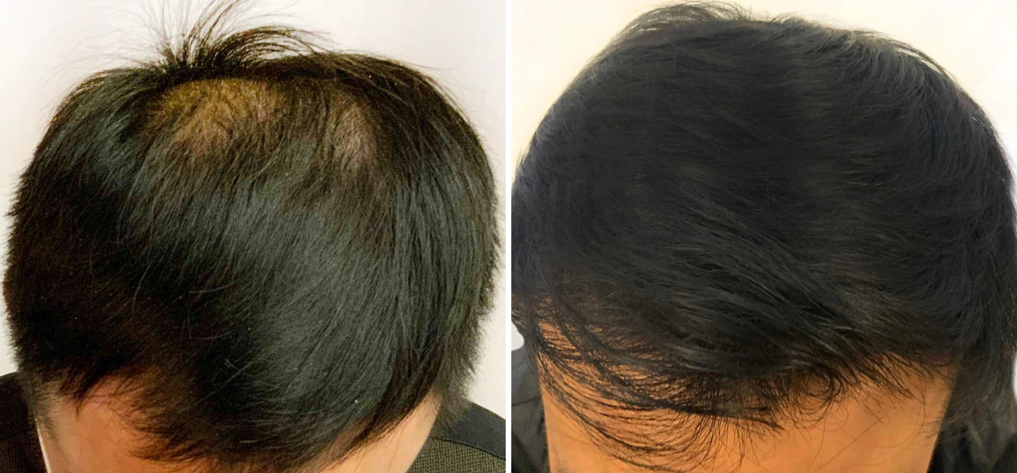 Before and after hair restoration: thinning vertex on left, full black hair on right