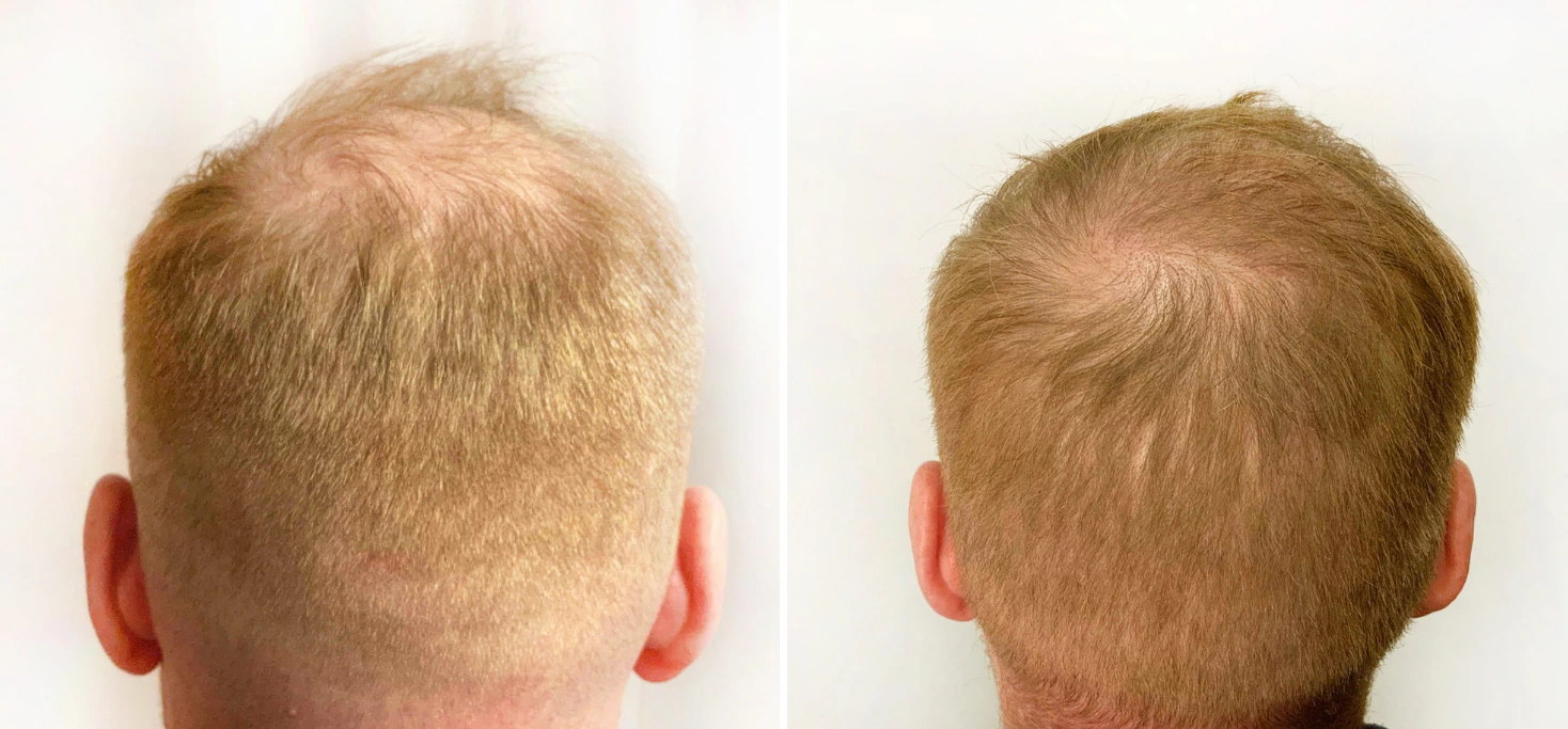 Before and after hair restoration: sparse blonde hair on left, fuller blonde hair on right