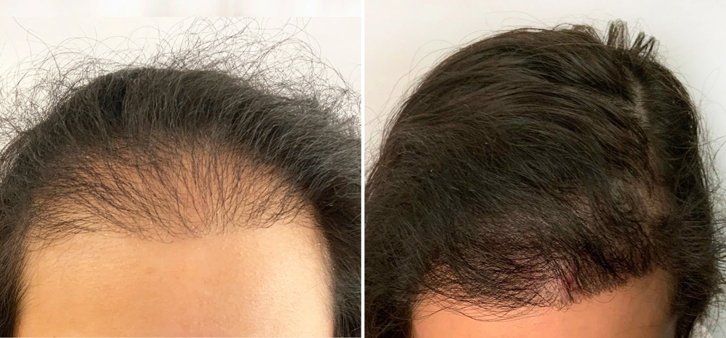 Before and after hair restoration showing increased density at hairline and crown