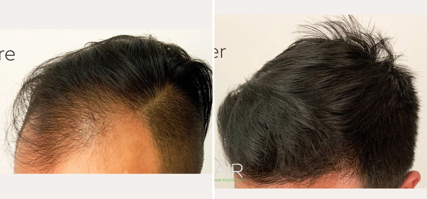 Before and after hair transplant showing fuller hairline and improved coverage