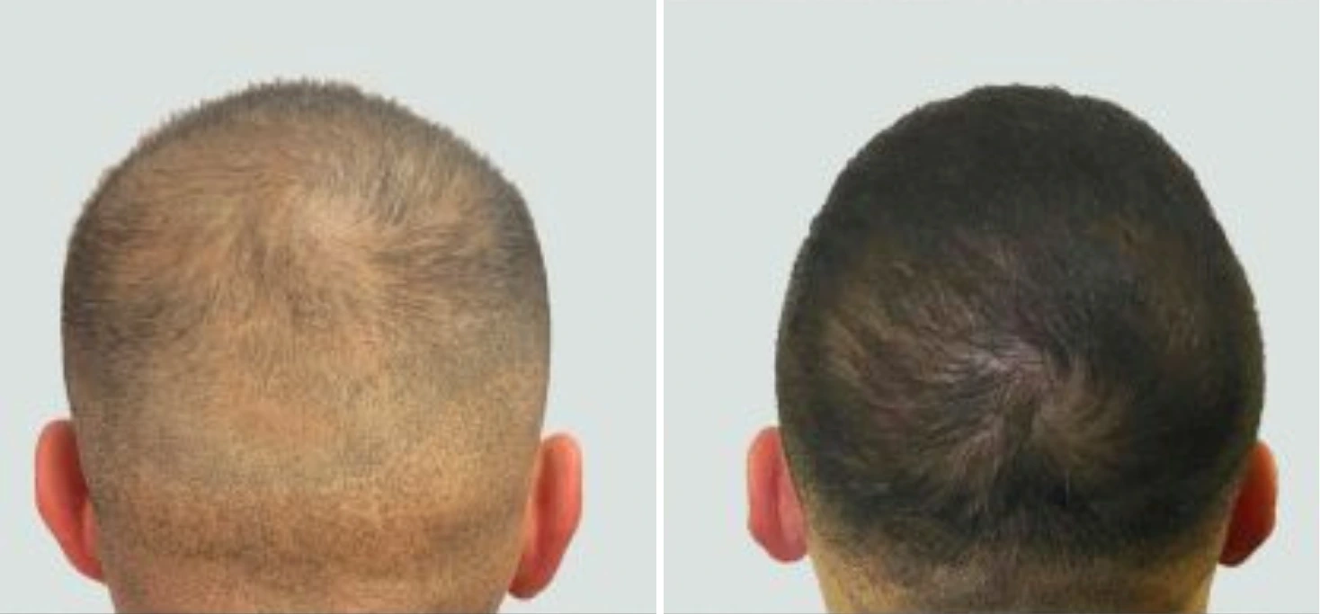 Before and after view from back of head showing restored hair growth on crown