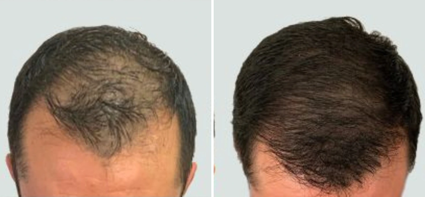 Before and after overhead view showing thickened hair at crown and vertex