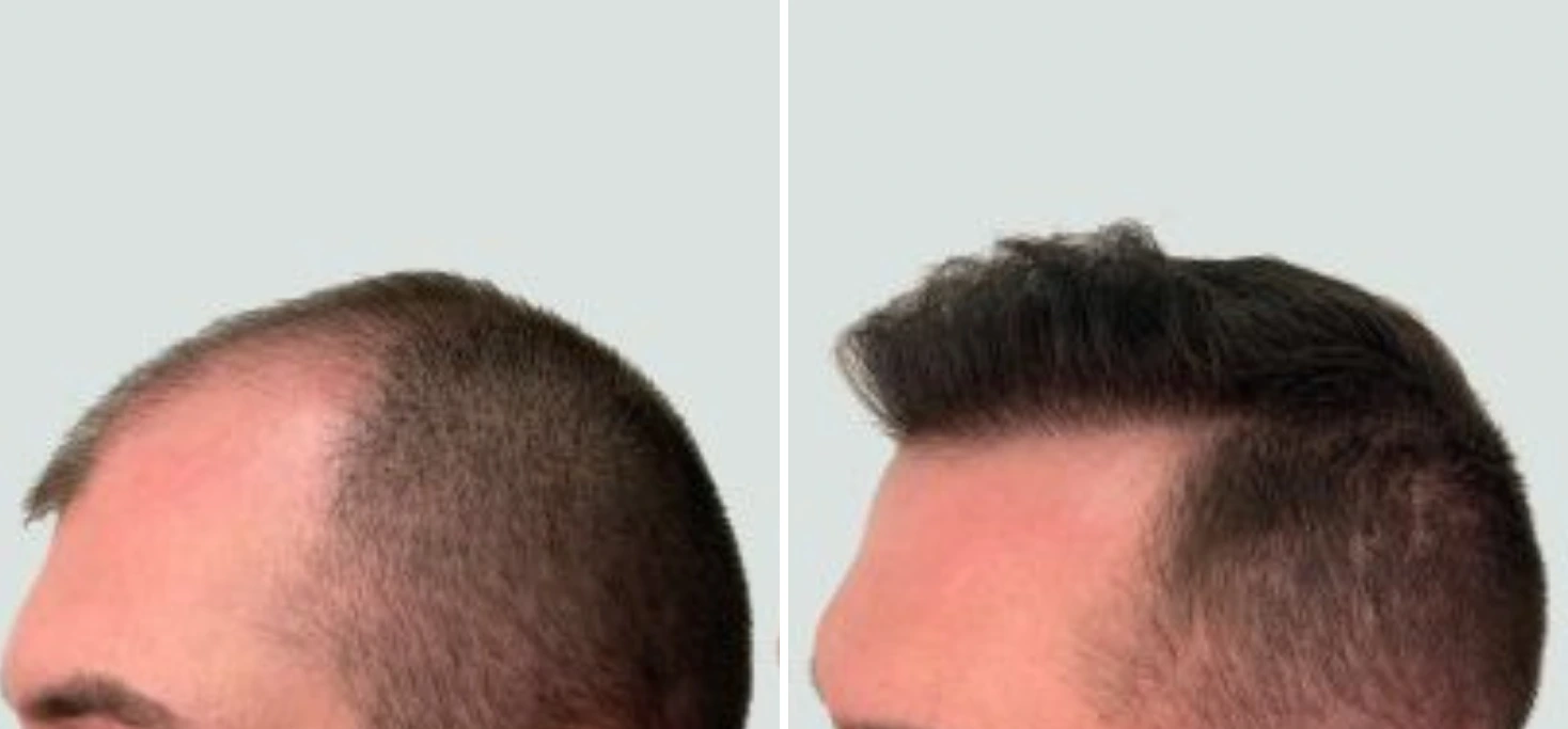 Before and after side profile showing hairline restoration and increased volume