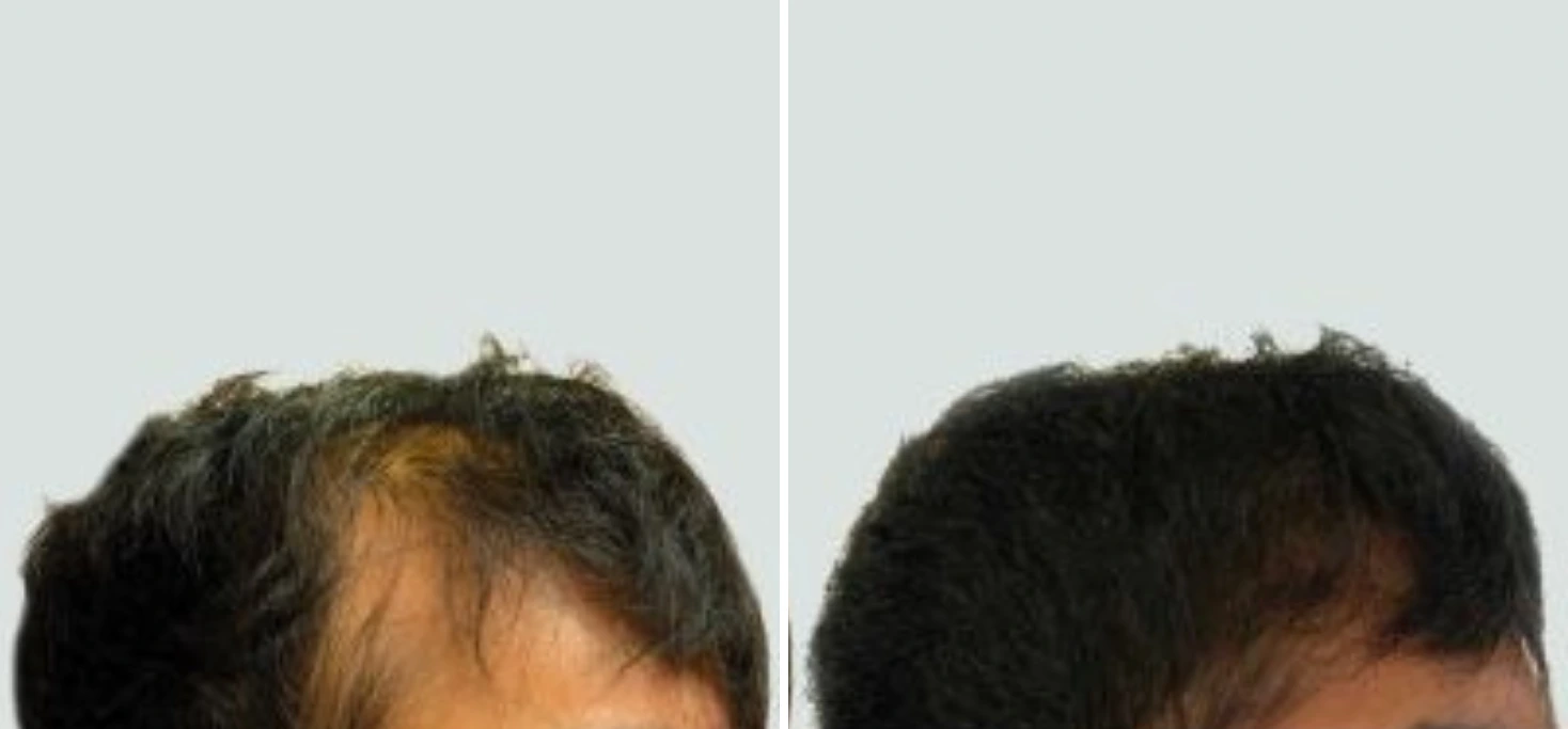 Before and after hair restoration showing thicker hair on crown with improved density