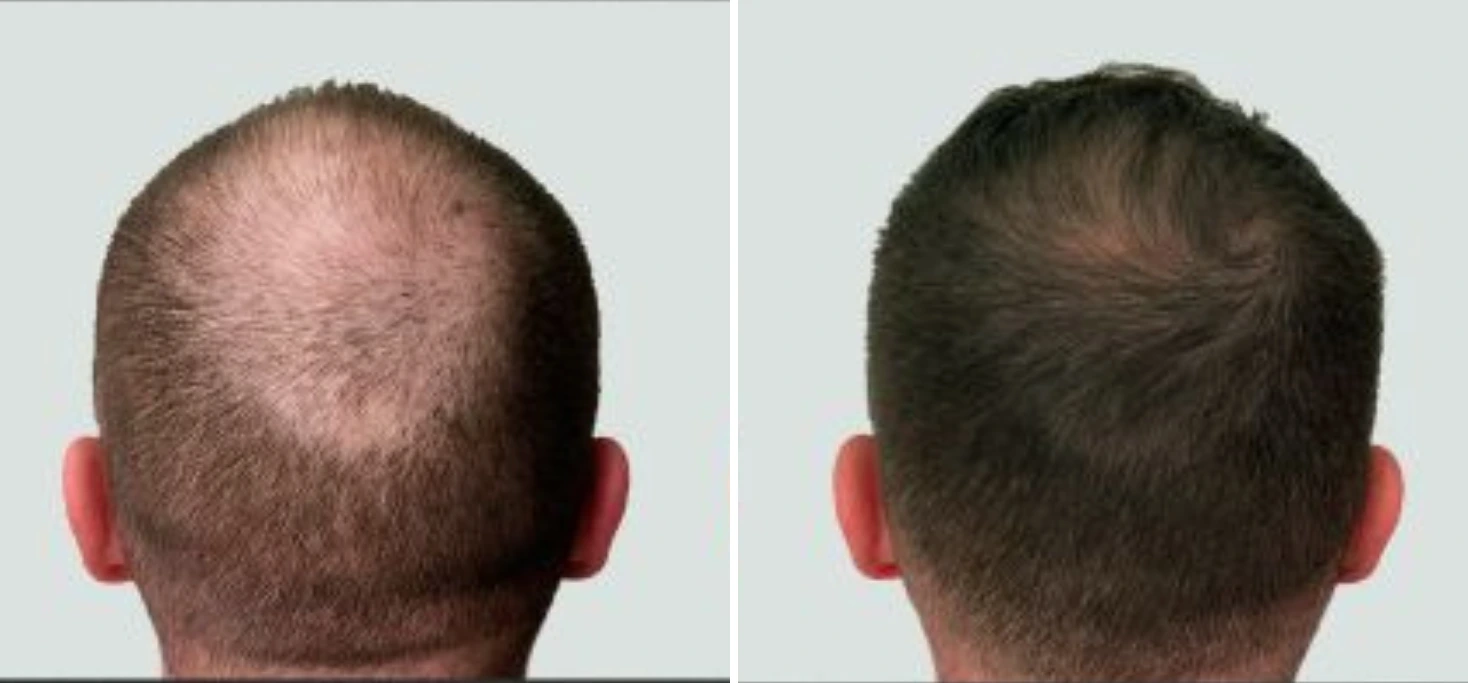 Before and after hair transplant showing back of head with restored hair growth