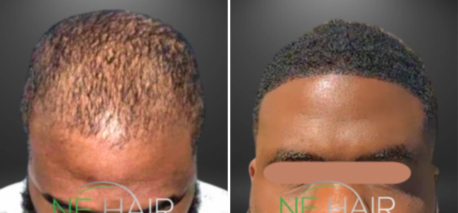 Before and after hair restoration displaying significant hair regrowth on crown with restored density and coverage