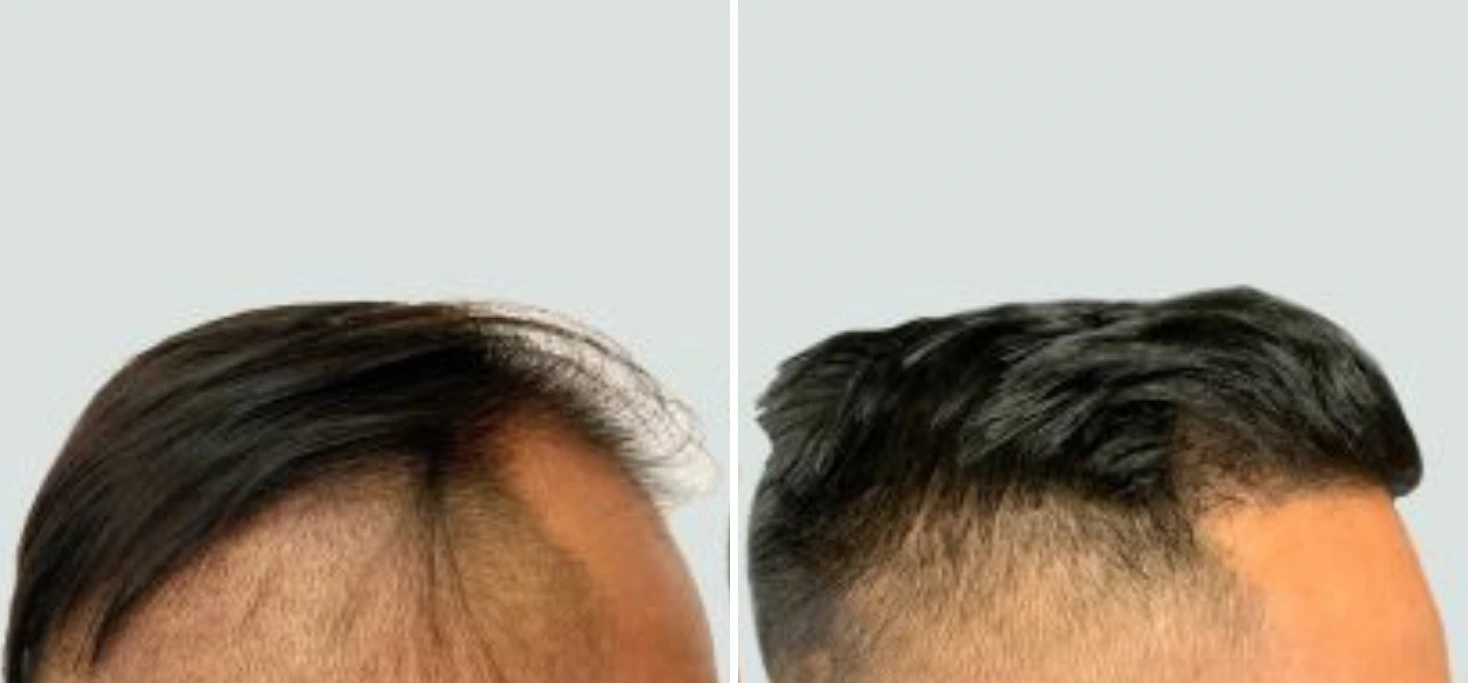 Before and after hair transplant showing hairline restoration and improved density