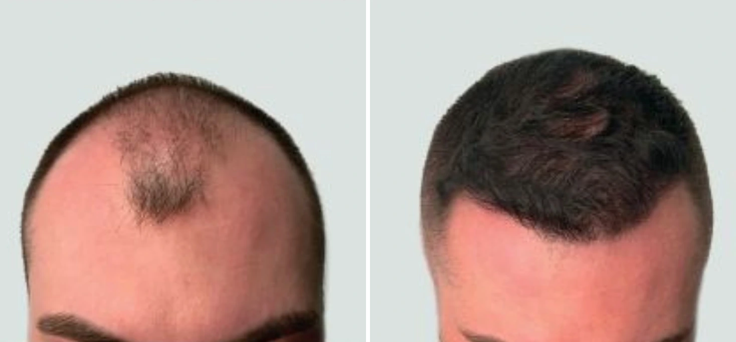 Before and after hair transplant showing crown area with restored dark hair growth