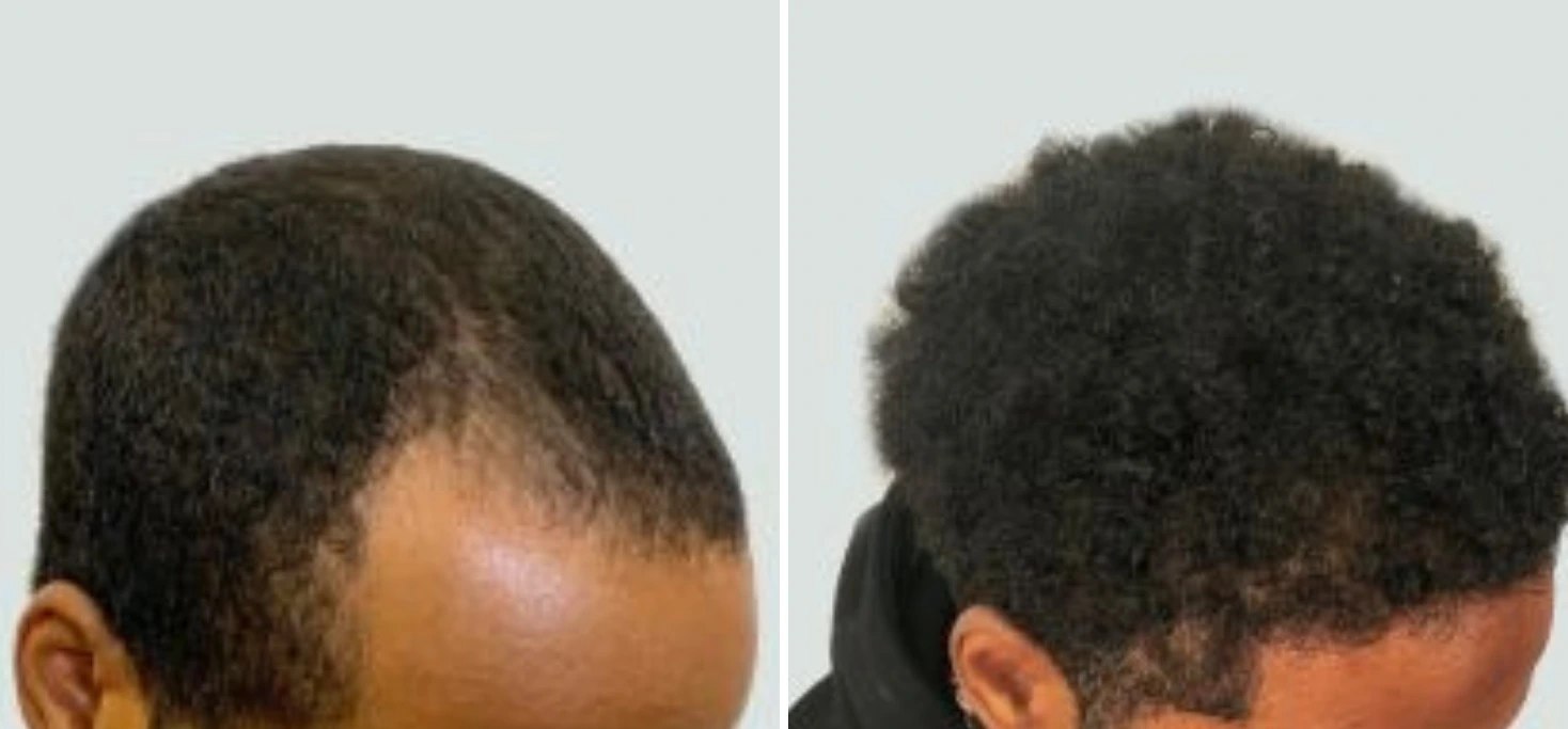 Before and after hair restoration showing increased hair density on top of head