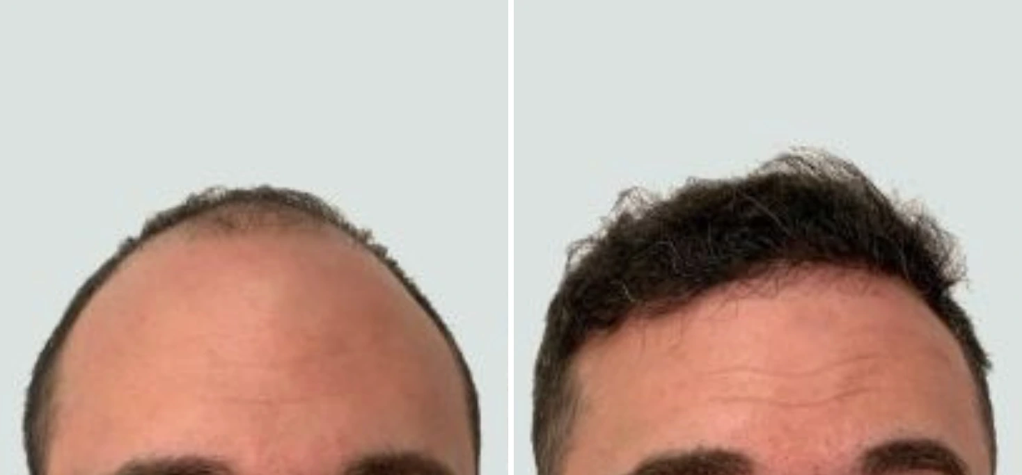 Before and after hair restoration showing fuller hairline and crown coverage