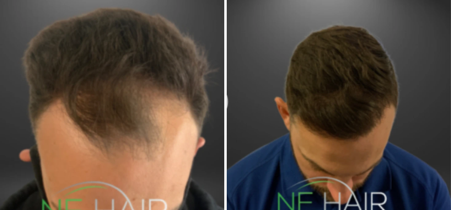 Before and after hair restoration showing back of head with hair loss treatment resulting in thicker hair growth